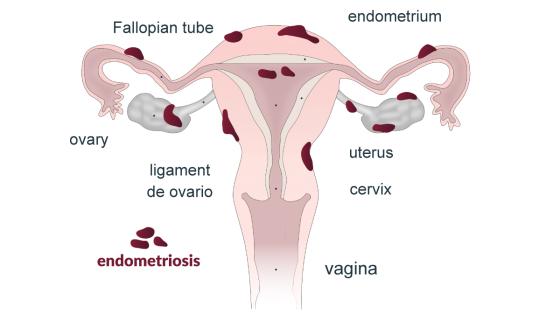 endometriosis